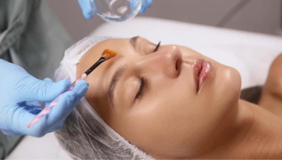 Sandra estética Tratamieneto peeling químico