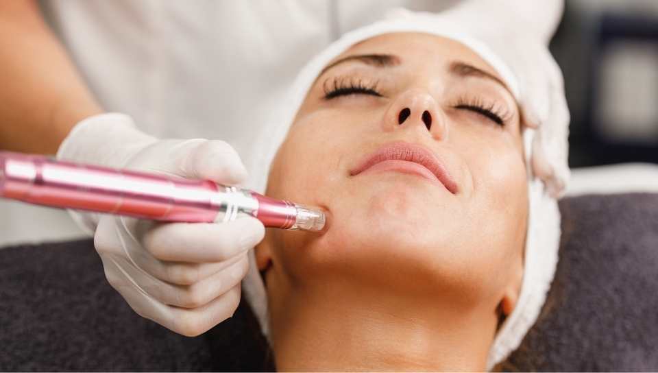Sandra estética tratamiento Dermapen