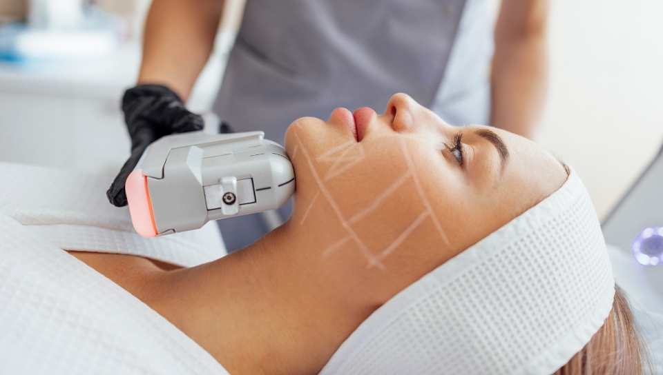 Santa Estética Lifting sin cirugía, HIFU facial